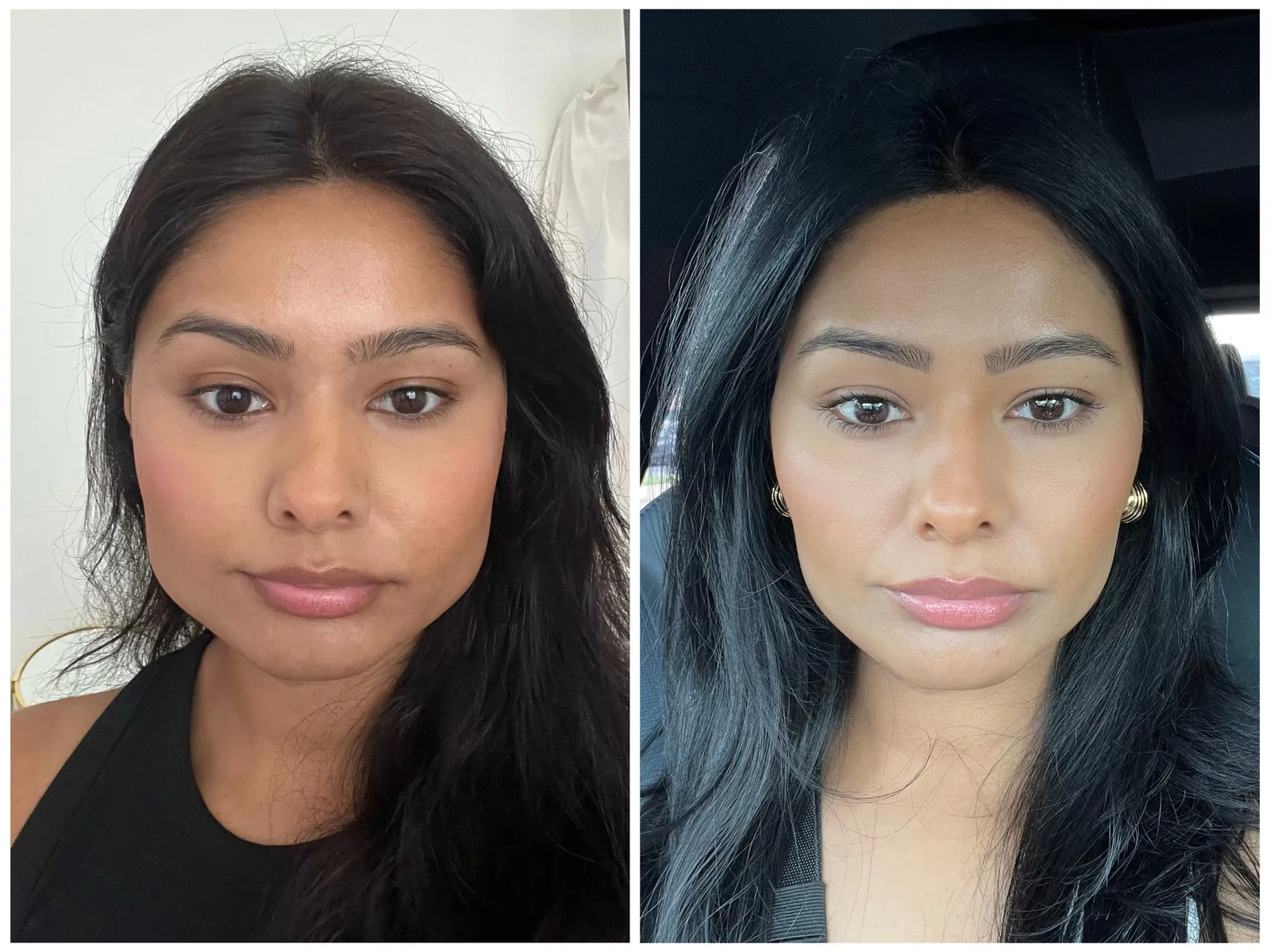 masseter botox before and after