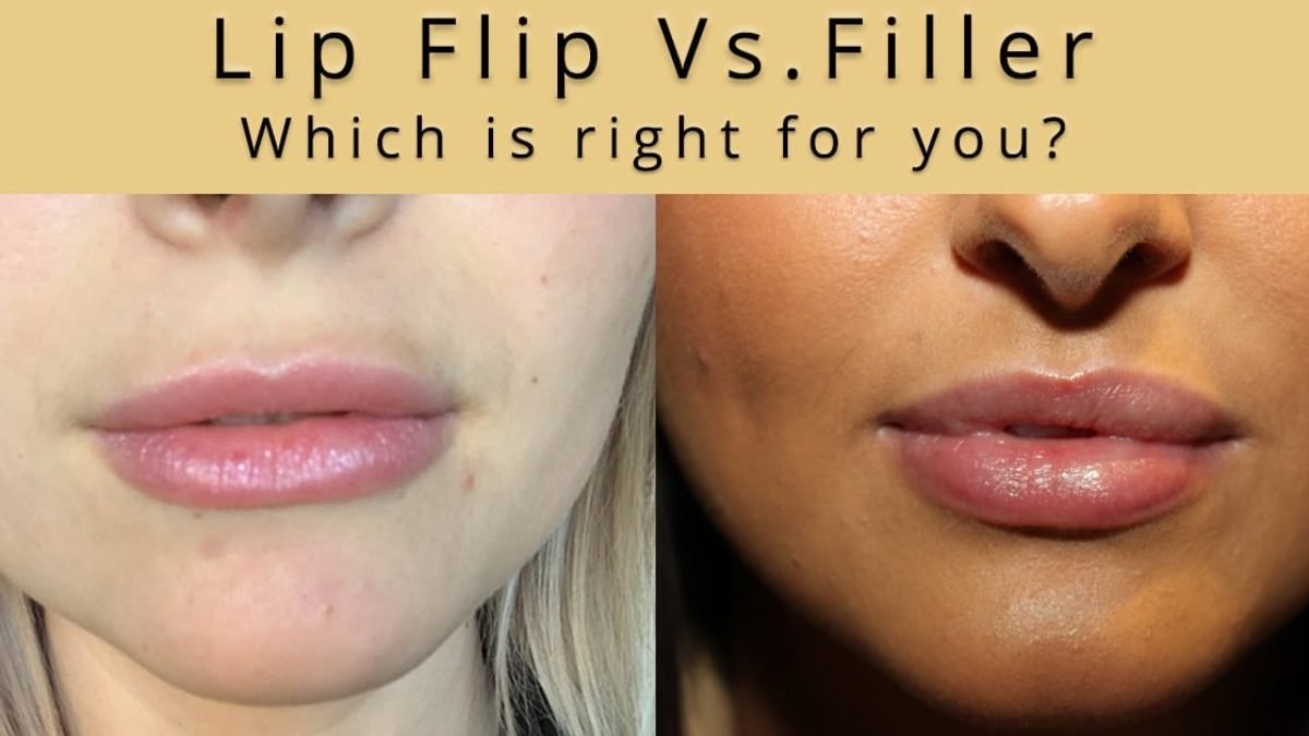 lip flip before and after