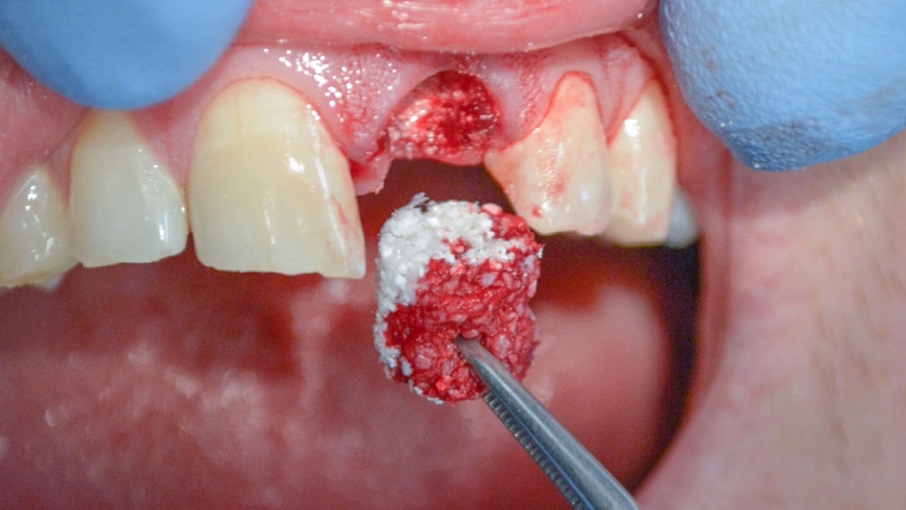 dental bone graft
