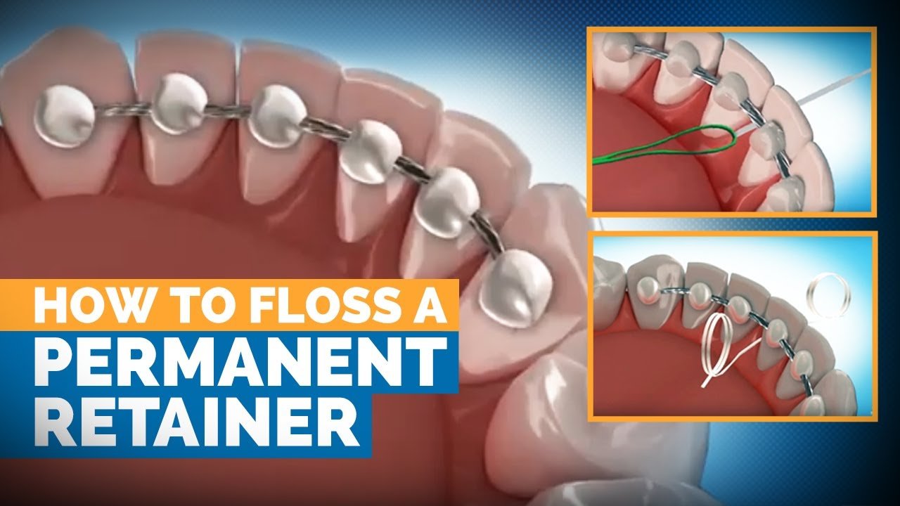 permanent retainer