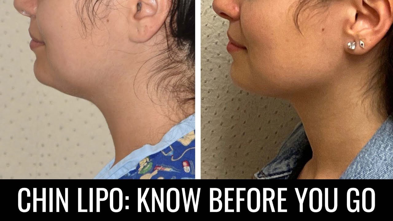 chin lipo