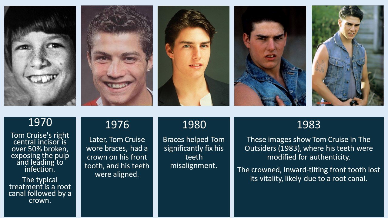 tom cruise teeth