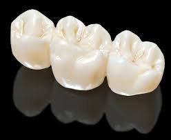 zirconia bridge